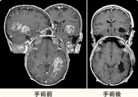 手術前と手術後のCT写真