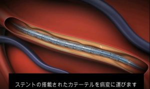 PCI動画