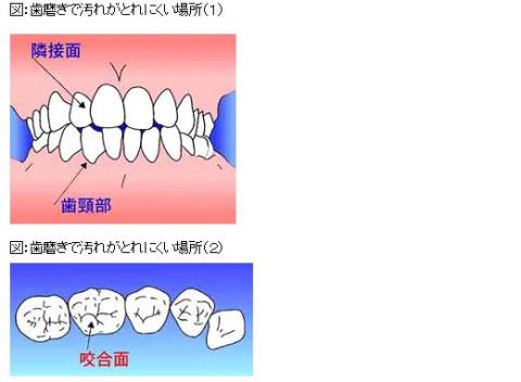 歯磨きで汚れがとれにくい場所