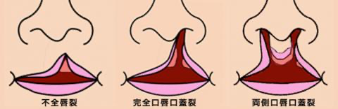 口唇裂イラスト 口唇裂イラスト